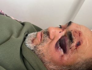 Ailesi İle Kayak Yapmaya Gitti Yaralandı