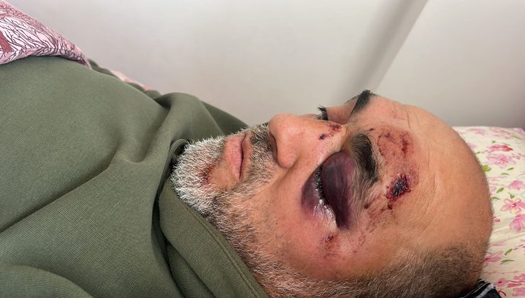 Ailesi İle Kayak Yapmaya Gitti Yaralandı